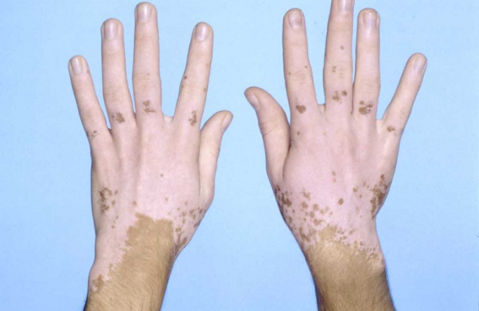 Vitiligo: cēloņi, diagnoze, ārstēšana